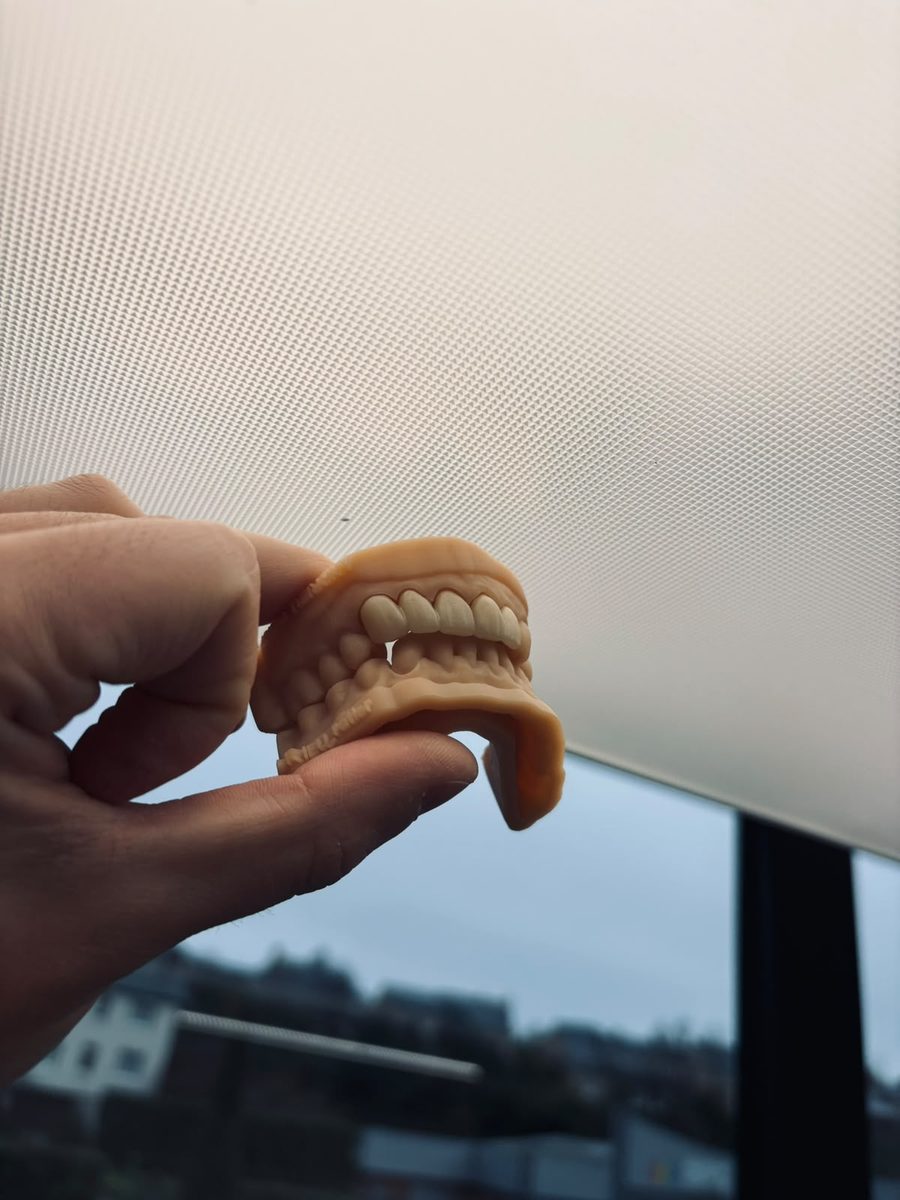 Bridge conjoint en zircone réalisé par DentoConcept